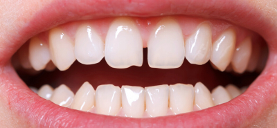 Diastema: quando i due denti incisivi superiori sono lontani fra loro