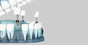 Il costo medio di un impianto dentale (di un singolo dente) quale può essere in Italia?