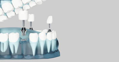 Il costo medio di un impianto dentale (di un singolo dente) quale può essere in Italia?