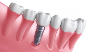 Implantologia dentale senza dolore