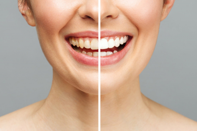 Sbiancamento dentale professionale per avere denti più lumnosi