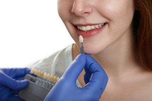 Faccette dentali: estetica per correggere imperfezioni dentali