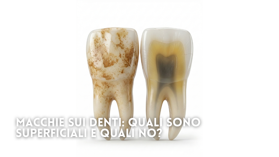Macchie sui denti: quali sono superficiali e quali no?