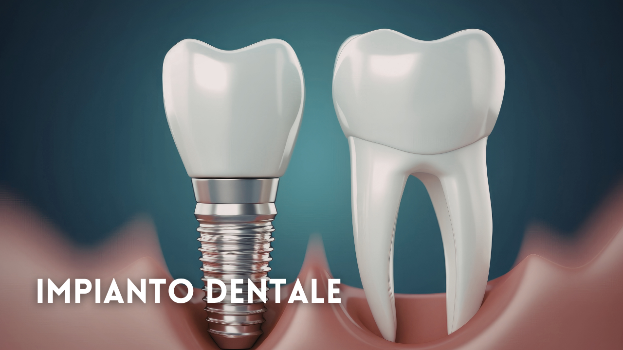 Impianto dentale: cosa succede nei primi 30 giorni