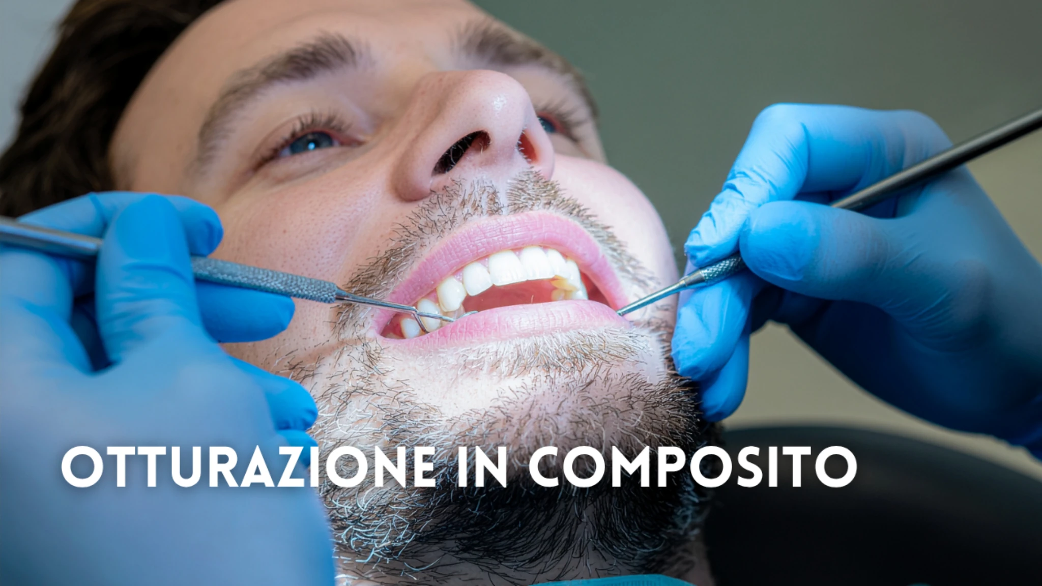 Otturazioni in composito: quando il bianco non basta e cosa fare