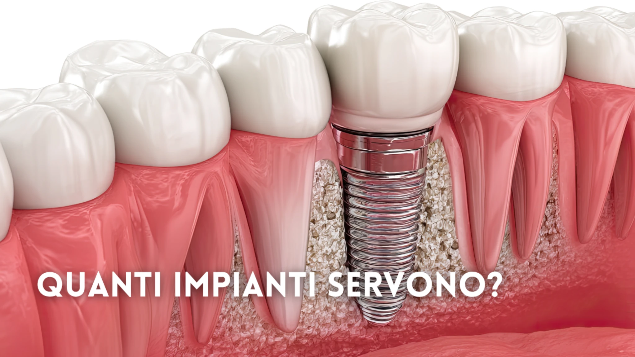 Quanti impianti servono? Singolo, multiplo e full arch a confronto