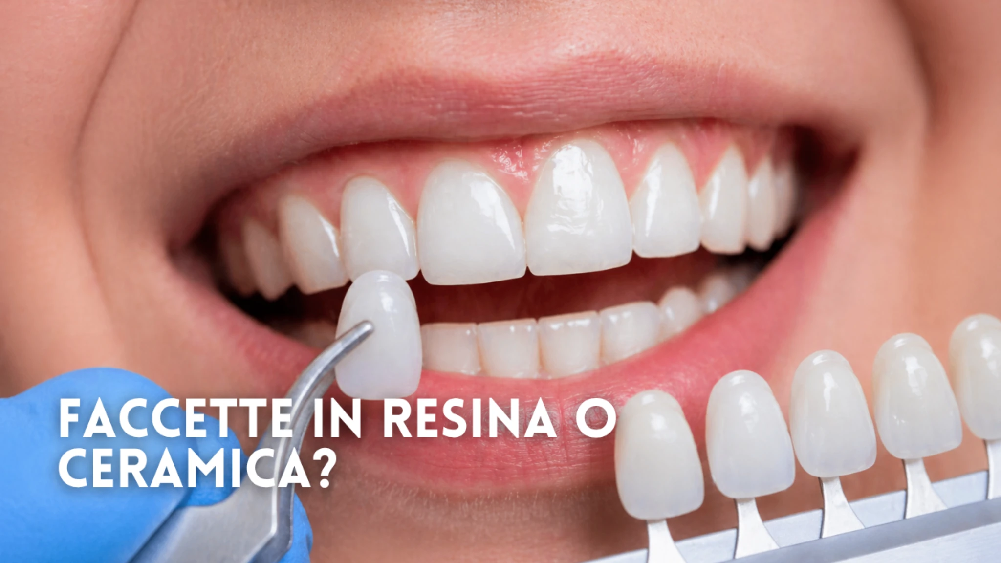 Faccette in resina o in ceramica: cosa cambia davvero