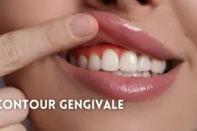 Contour gengivale: quando rimodellare le gengive cambia tutto il sorriso