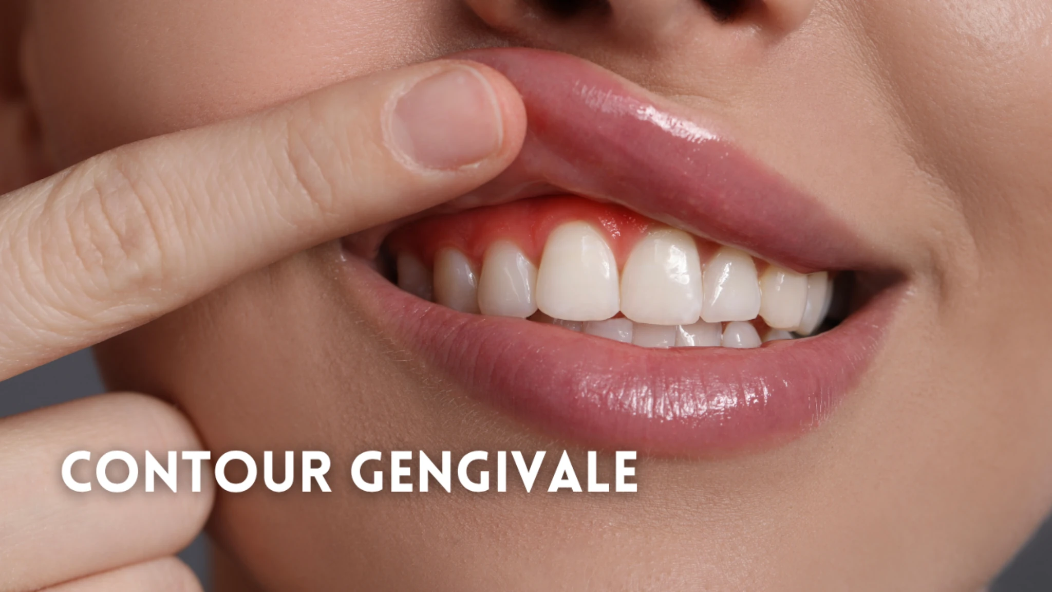 Contour gengivale: quando rimodellare le gengive cambia tutto il sorriso