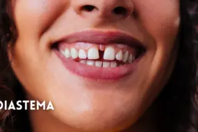 Diastema: quello spazio tra i denti va sempre corretto?