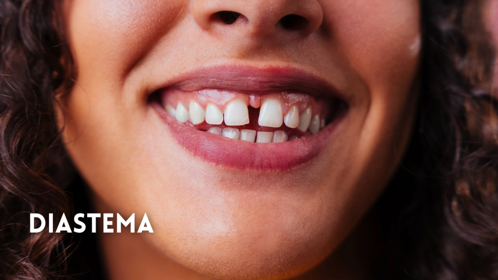 Diastema: quello spazio tra i denti va sempre corretto?