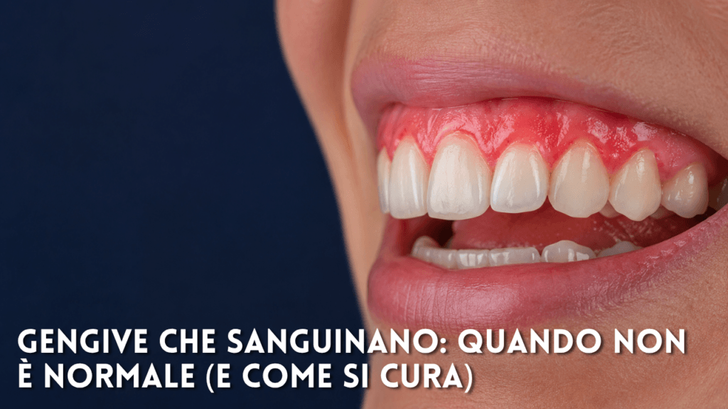Macrofotografia clinica di una bocca leggermente aperta, con denti naturali e gengive superiori arrossate e leggermente infiammate lungo il bordo gengivale. Il lato sinistro dell'immagine presenta uno spazio blu scuro, mentre il testo in sovrimpressione recita: “Gengive che sanguinano: quando non è normale (e come si cura)”.